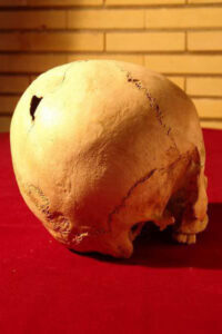 5,000-Year-Old Skull Reveals Iran’s Medical Advances