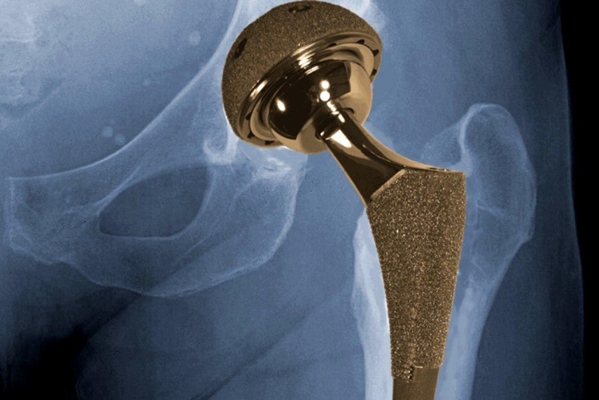 Iranian Researchers Produce Artificial Hip Joint