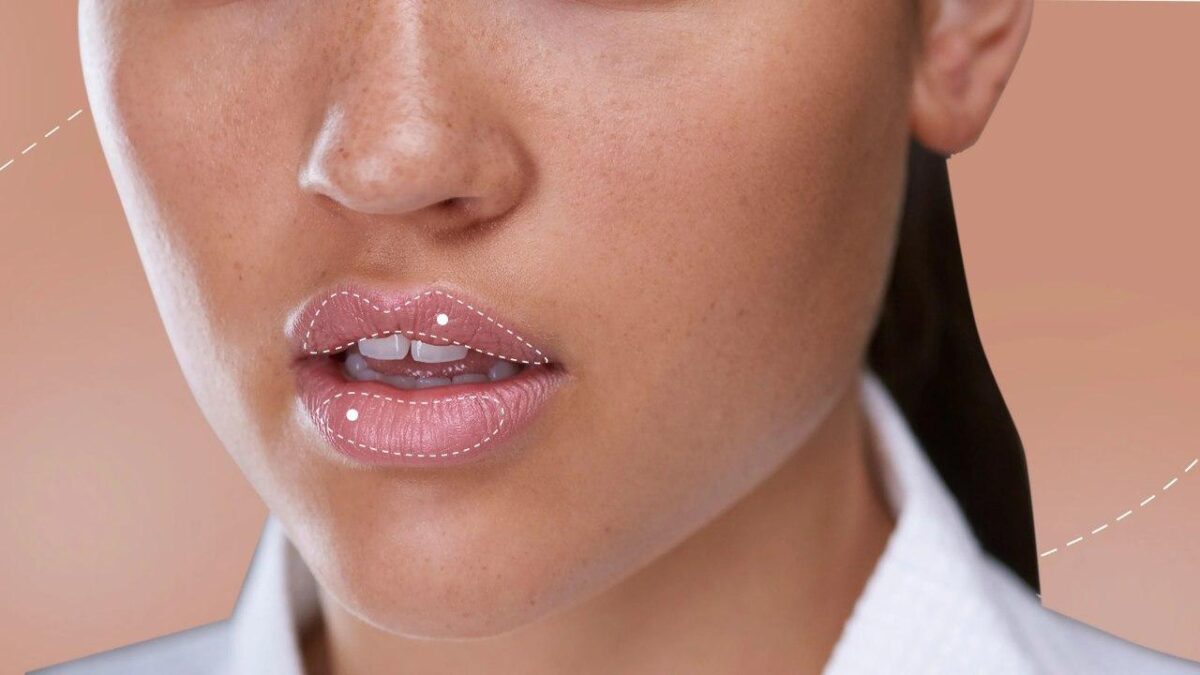 Lip Augmentation and Facial Beauty