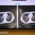 Iran Unveils COVID-19 Pneumonia Diagnosis System