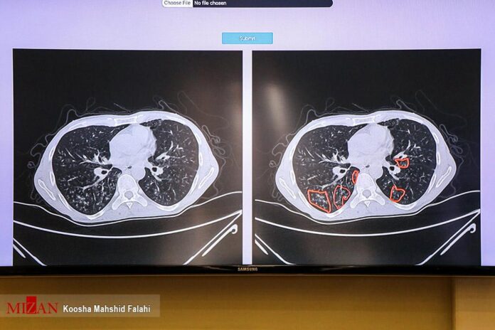 Iran Unveils COVID-19 Pneumonia Diagnosis System