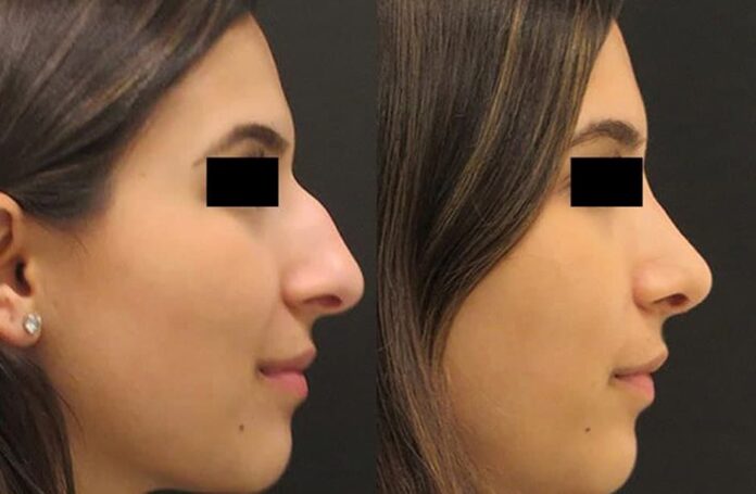 Nose Job in Iran – 26 Tips for Rhinoplasty