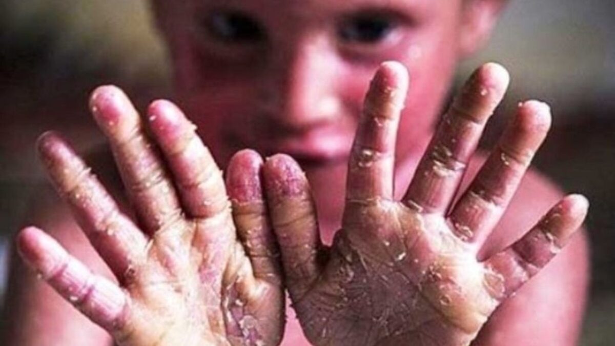 Some Iranian EB patients have died because of U.S. sanctions