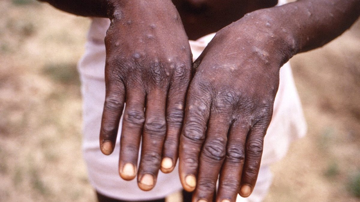 Health official: No monkeypox cases in Iran yet 1 Monkeypox