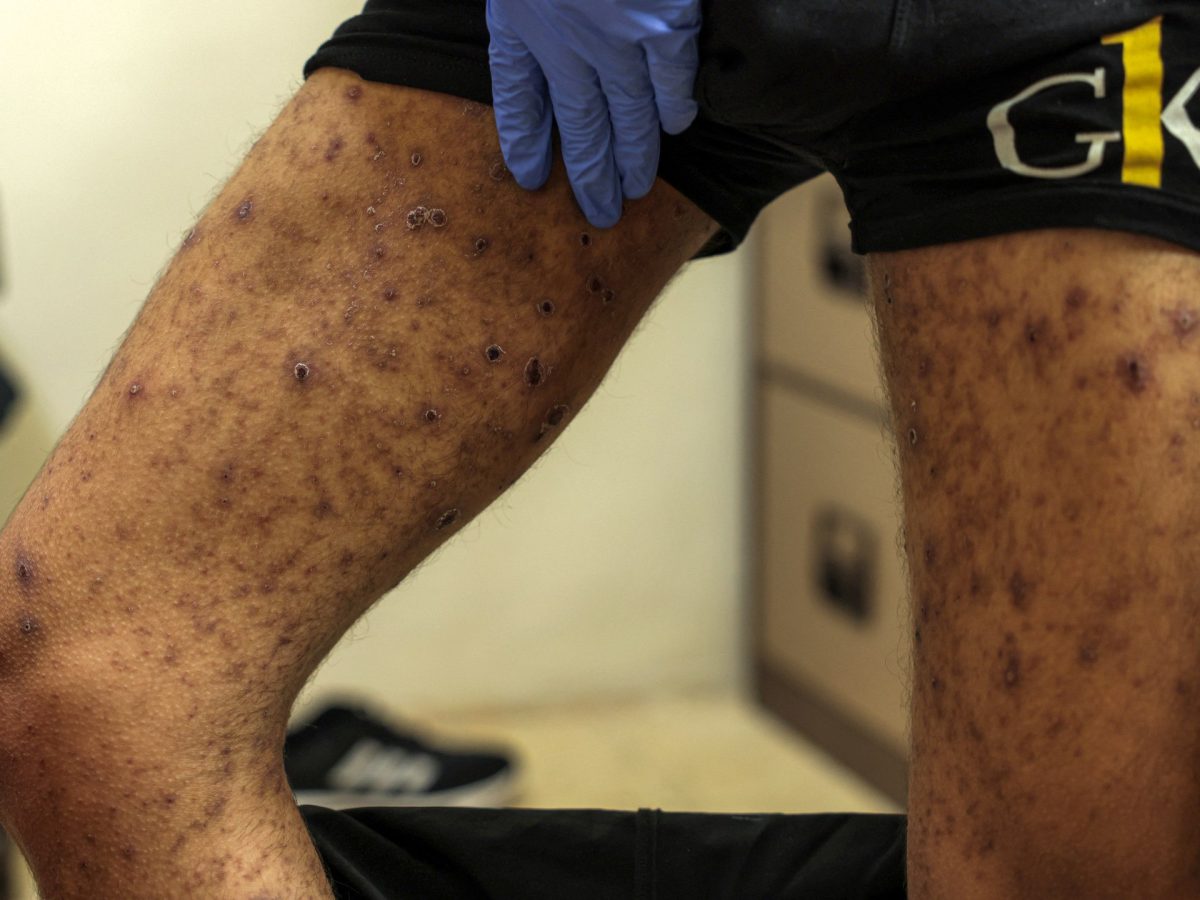 Palestinians freed by Israel show signs of ‘torture, starvation’ 1 Palestinians freed by Israel show signs of ‘torture, starvation’